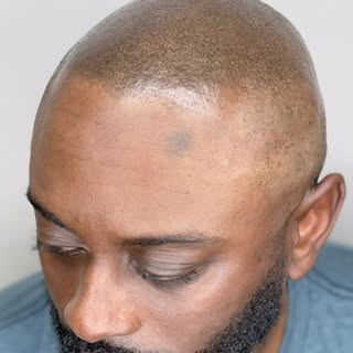 Amazing SMP results! This client flew from Oakland, California for natural looking results 👉🏾 see 