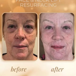 After being quoted more than $40,000 for a surgical face and neck lift in Brazil, this client chose 