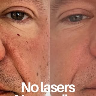 We’re endlessly excited about facelifts with plasma energy. Lifted eyelids. Clearer skin. Better tex
