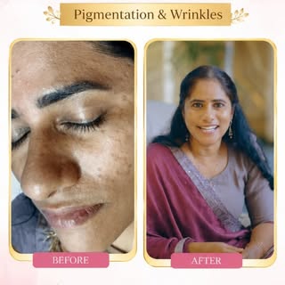 Kalpana had been dealing with dull-looking skin and weight gain for a few years. She tried different