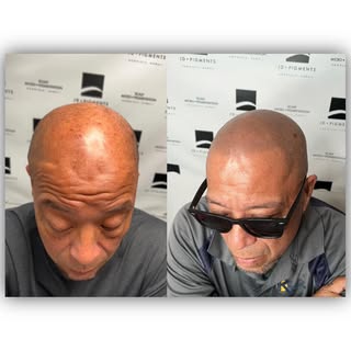 Hair loss camouflage complete! 😎

SMP is a life changing hair loss treatment that recreates hair fo