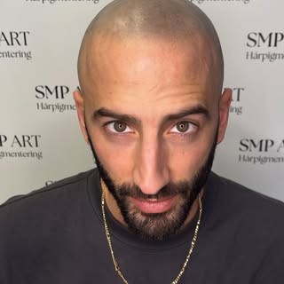 Före ➡️ Efter
Naturlig SMP / Scalp Micropigmentation för en skarpare hårlinje och tätare look.
📍Sto