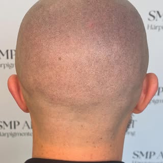 FUE-ärr efter hårtransplantation – går det att dölja?

På bilden ser du hur vi har kamouflerat bort 