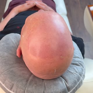 Session 1 genomförd för en person med alopeci areata som fått SMP-behandling via rekvisition.
Behand