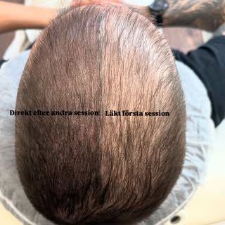Scalp Micropigmentation Hårtätning på kort hår ✨ 

Läkt efter session 1 ➡️| Direkt efter session 2 ⬅