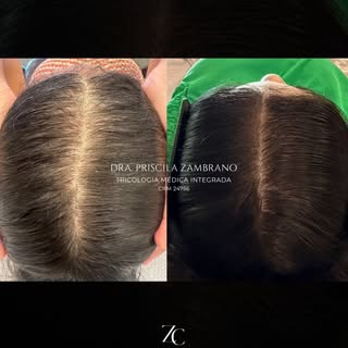 Relato de caso clínico.

Mulher, 30+
Diagnóstico de Alopecia Androgenética Feminina com componente i