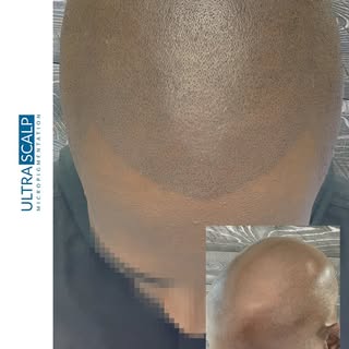 2 sessions 1 to go

Follicule Black

ultrascalpmicropigmentation
ULTRA SCALP IS NEW TO IG!!!

Celebr