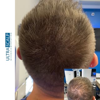 Scalp Micropigmentation For Adding Density To Thin Areas. 3 Sessions 

#tampabay #tampaflorida #spri