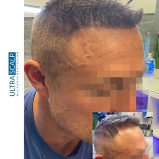 After a hair transplant you may still look very thin. Add the illusion of more density with Scalp Mi