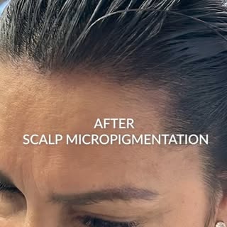 Scalp MIcropigmentation Tampa- Add the look of Density To Thinning Hair for Women.
https://www.ultra
