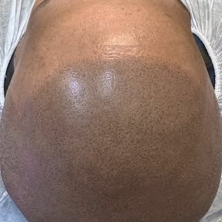Call today for a free Scalp Micropigmention consultation with Ultra Scalp. 

#scalpmicropigmentation