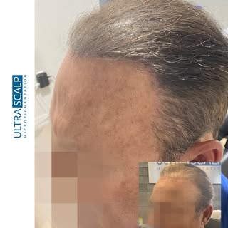 If you are suffering with density issues 
with your hair consider Scalp Micropigmentation. Call or v