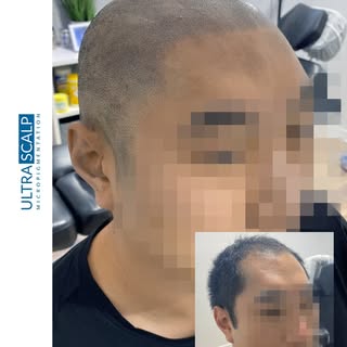 Hairline Restoration with Scalp Micropigmentation. This is right after 3rd session so a bit red stil
