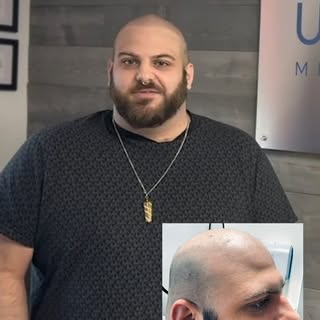 Scalp MIcropigmentation Tampa- Add the look of more density or Get Your Hairline Back with the shave