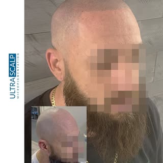 Client wanted the edged up hairline. If you are looking to get your hairline back visit our website 