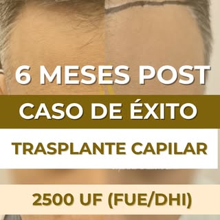 🔥 ¡𝐈𝐦𝐩𝐫𝐞𝐬𝐢𝐨𝐧𝐚𝐧𝐭𝐞 𝐜𝐚𝐦𝐛𝐢𝐨 𝐞𝐧 𝐬𝐨𝐥𝐨 𝟔 𝐦𝐞𝐬𝐞𝐬!🔥
💥 Resultado real, técnic