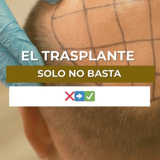 Un trasplante de baja densidad, mal diseño y sin tratamiento puede hacer que la alopecia siga avanza