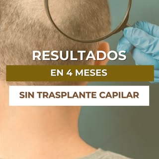 🚨 ¿Te dijeron que la única solución era el trasplante capilar?

Paciente de 42 años.
Alopecia leve 