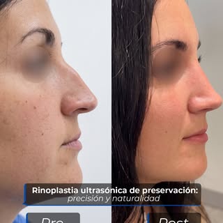 La rinoplastia ha evolucionado gracias a técnicas cada vez más precisas y menos invasivas. 👃

En es