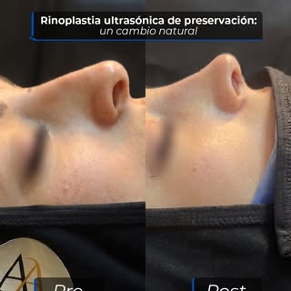 Cada rinoplastia es única y se planifica respetando la armonía facial de cada paciente. 

En este re