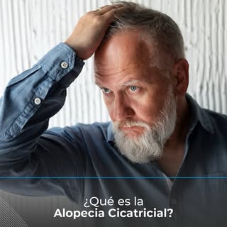 No toda caída es igual. La alopecia cicatricial implica destrucción del folículo, por eso el diagnós
