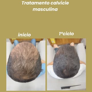 Sequência de resultados do protocolo exclusivo da clínica para tratamento de calvície,alopecias,qued