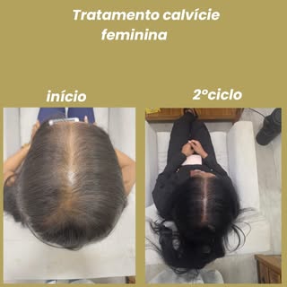 Calvície feminina mulher jovem! Resultado de 2 ciclos,e seguimos na manutenção mensal!