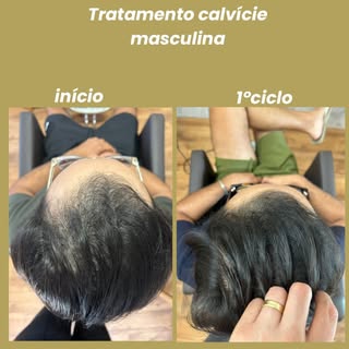 Resultado de 1 ciclo de tratamento para calvície masculina! Agende sua avaliação gratuita! #calvicie