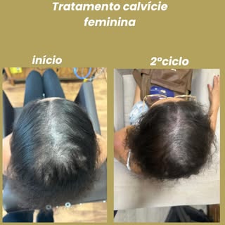 Resultado de 2 ciclos calvície feminina estágio avançado! #calviciefeminina #alopeciaandrogénica #qu