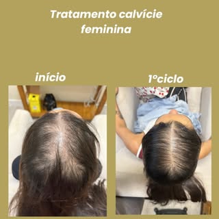 tratamento calvície feminina(mulher jovem) estágio avançado! Ainda temos um longo caminho pela frent
