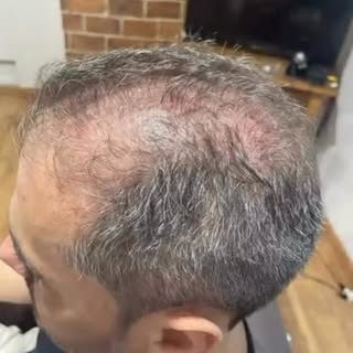 Resultados dos nossos protocolos individualizados!
Cada alopecia um tratamento específico e personal