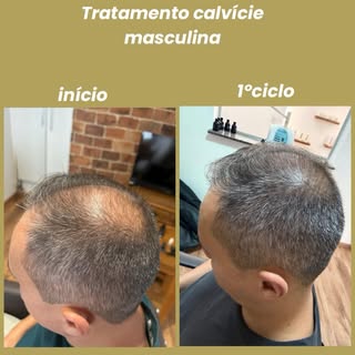 Resultado tratamento calvície masculina estágio avançado ! Tem resultados que são inacreditáveis!  #