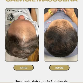 Calvície masculina estágio já avançado! Evolução visível da parte frontal!. Agende sua avaliação!
