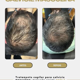 Tratamento para calvície masculina,o resultado não acontece da noite para o dia. Persistência,intens