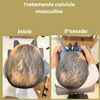 Tem resultados que aparecem muito rápido. Nesse caso,na quinta sessão já vemos um diferença enorme! 