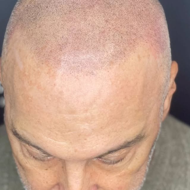 A lot of people ask can you do this procedure even if you have gray hair ? The answer is YES!!! To s
