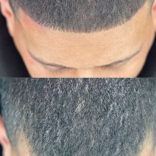 He said it !! LOOK AT THAT S**t !
 #xposedsmp #xposedcosmetics #smp #hairtattoo #tattoohair #microbl