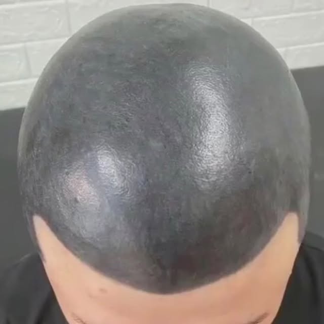 Losing hair really sucks !

Thank god there is a solution to this ! 
It is called scalp micro pigmen