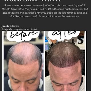 Queens, NYC🗽Stop worrying about your balding - I got you covered!

From master hairline placement, 