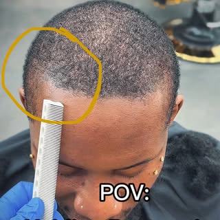 This is SMP a semi-permanent Hairloss solution (recommended maintenance period 3-5 years with proper