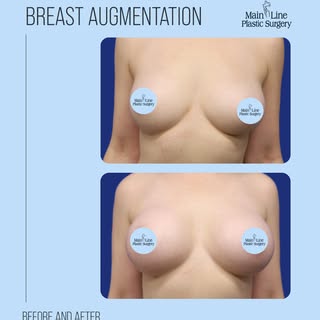 Our patient came in seeking a subtle but meaningful enhancement to better balance her overall propor