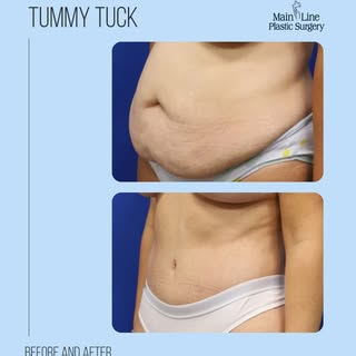 This before & after by Dr. Jean shows what’s possible when excess skin is removed and abdominal musc