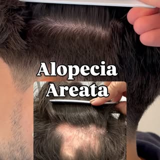 Alopecia Areata 100% revertida! 🎊🎉

Paciente jovem, com histórico antigo de alopecia areata. Unind