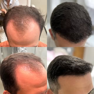 7 meses de evolução após o Transplante Capilar FUE. 

Paciente mora fora do nosso Estado e enviou as