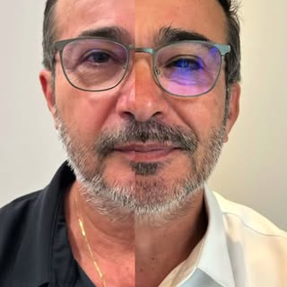 ✅ 9 meses de pós-operatório 

Em comparação com o resultado de 6 meses, percebemos um aumento da den