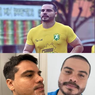 Nosso paciente @rafaelsantos.corretor e sua excelente recuperação após transplante de barba e rebaix