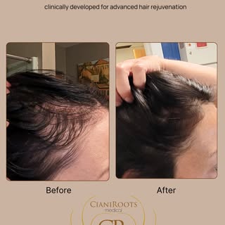 Noticing more hair shedding, a wider part, or areas that just don’t feel as full as they used to?
A 