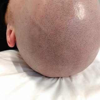Vaizdas iškarto po 3čio seanso. #scalpmicropigmentation #tagingpliki #selfconfidence #ecuri #ecuripi