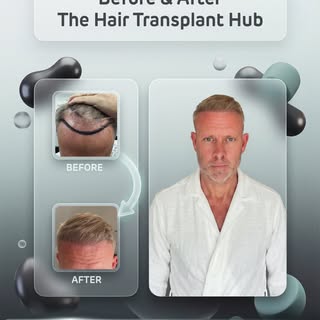 Procedure : Fue hairtransplant 6 months post

Grafts : 3000

1 day procedure 

#beforeandafter #hair