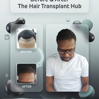 Procedure : Fue hairtransplant 6 months post

Grafts : 2000

1 day procedure 

#beforeandafter #hair